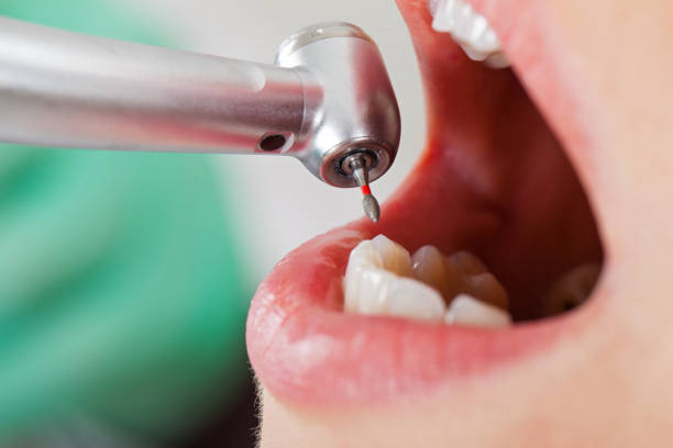 Best Emergency Root Canal Treatment in Palatine, IL